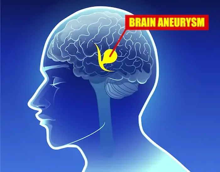 Brain Aneurysms